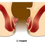 1 стадию невозможно определить визуально