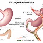 анастомозит после резекции желудка лечение