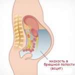 Асцит брюшной полости при онкологии лечение отзывы