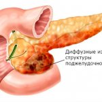 Диффузные изменения в паренхиме поджелудочной железы, обычно говорят о замещении железистой ткани рубцами или жировыми клетками