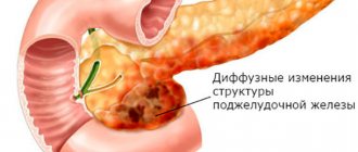 Диффузные изменения в паренхиме поджелудочной железы, обычно говорят о замещении железистой ткани рубцами или жировыми клетками