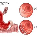 Gastritis foci