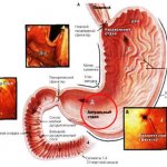 Гиперплазия антрального отдела желудка