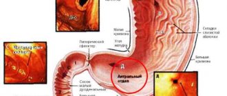 Гиперплазия антрального отдела желудка