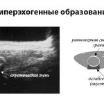 гипоэхогенные образования