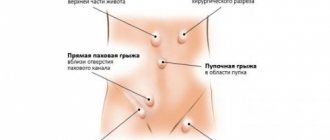 A hernia provokes dysfunction of the organs of the system where the hernial sac is located