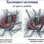 cholecystectomy of the gallbladder