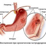 Хронический гастродуоденит - симптомы и лечение