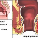 как выглядит парапроктит