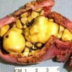 Gallstones