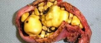 Gallstones