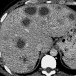 Metastases in the liver