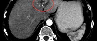 Focal formations of the liver