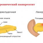 Панкреатит у женщин