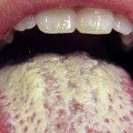 Причины и лечение жжения во рту и на языке