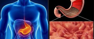Рак антрального отдела желудка: особенности заболевания