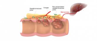 Rectal cancer is an oncological disease that is often fatal