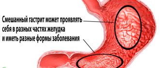 Mixed gastritis of the stomach