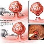 polyp removal