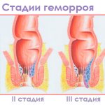 В медицинской практике принято выделять 4 стадии геморроя. Данная классификация актуальна для внутреннего геморроя. При наружном расположении узлов принято учитывать не степень их увеличения, а наличие или отсутствие осложнений.