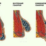 Types of hemorrhoids