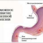 Возможное развитие язвенной болезни